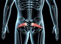 Piriformis muscle, trigger points, and pain 